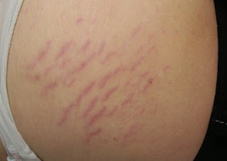 Estrias rojas en axilas_2